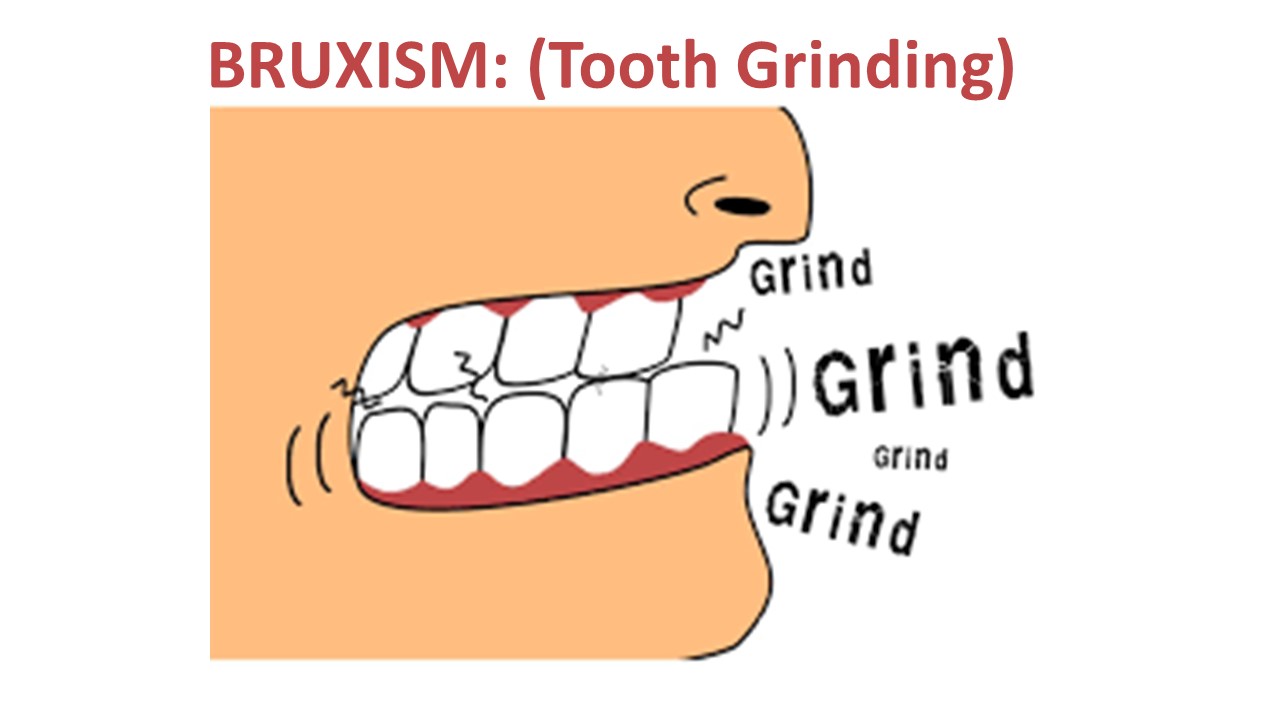 All About Bruxism Tooth Grinding Dallas Dental Implant Center 0496